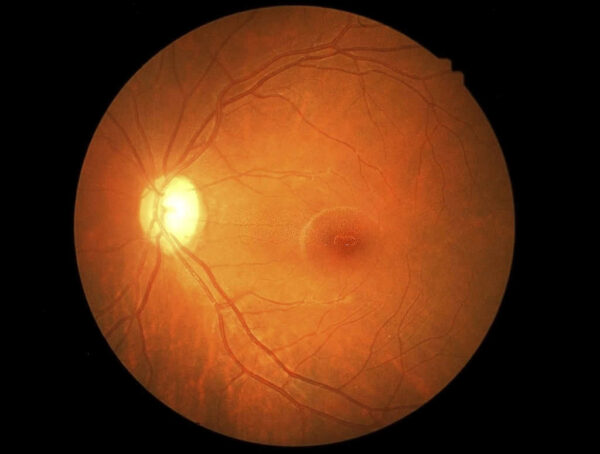 تأثير مرض السكري على شبكية العين