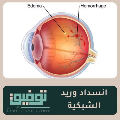 إنسداد وريد الشبكية