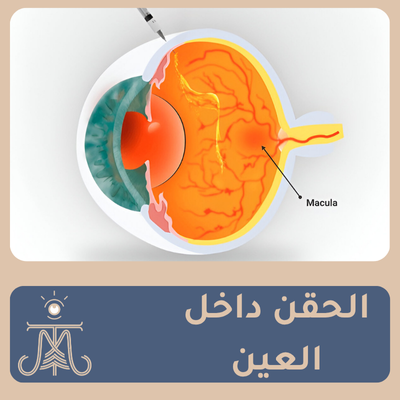 الحقن داخل العين