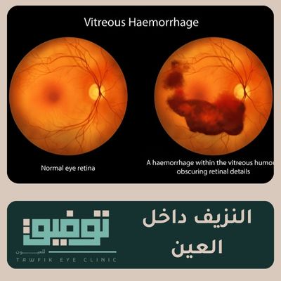 النزيف في العين