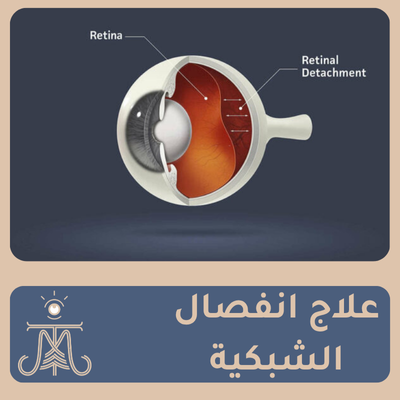 انفصال الشبكية