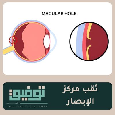 ثقب مركز الإبصار