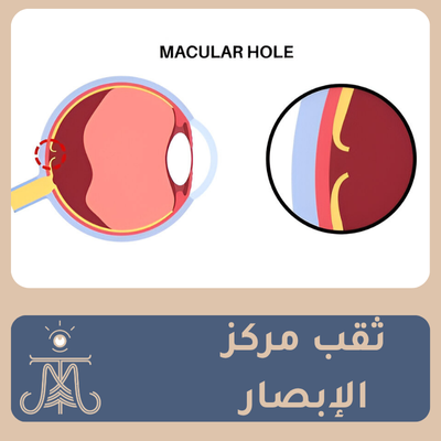 ثقب مركز الابصار