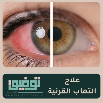علاج التهاب القرنية