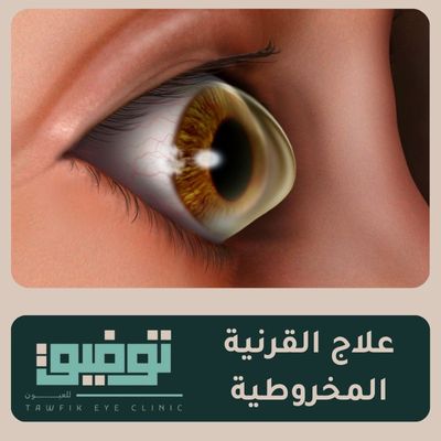 علاج القرنية المخروطية