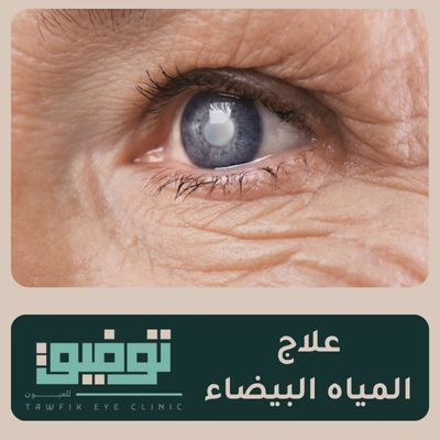 علاج المياه البيضاء