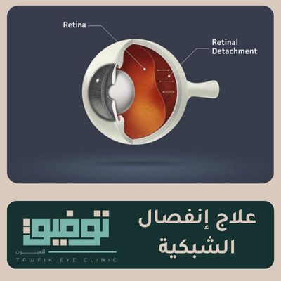 علاج انفصال الشبكية