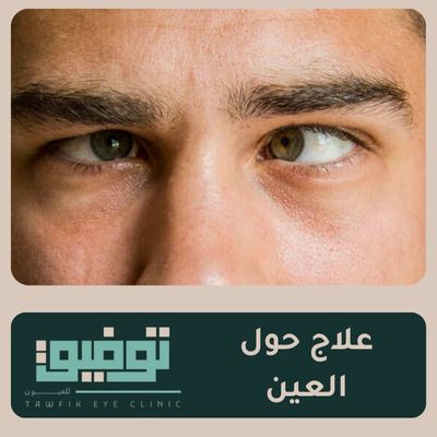 علاج حول العين