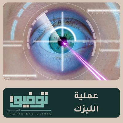 عملية الليزك