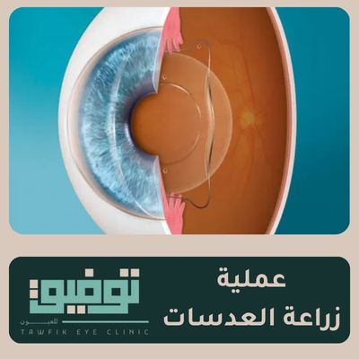 عملية زراعة العدسات